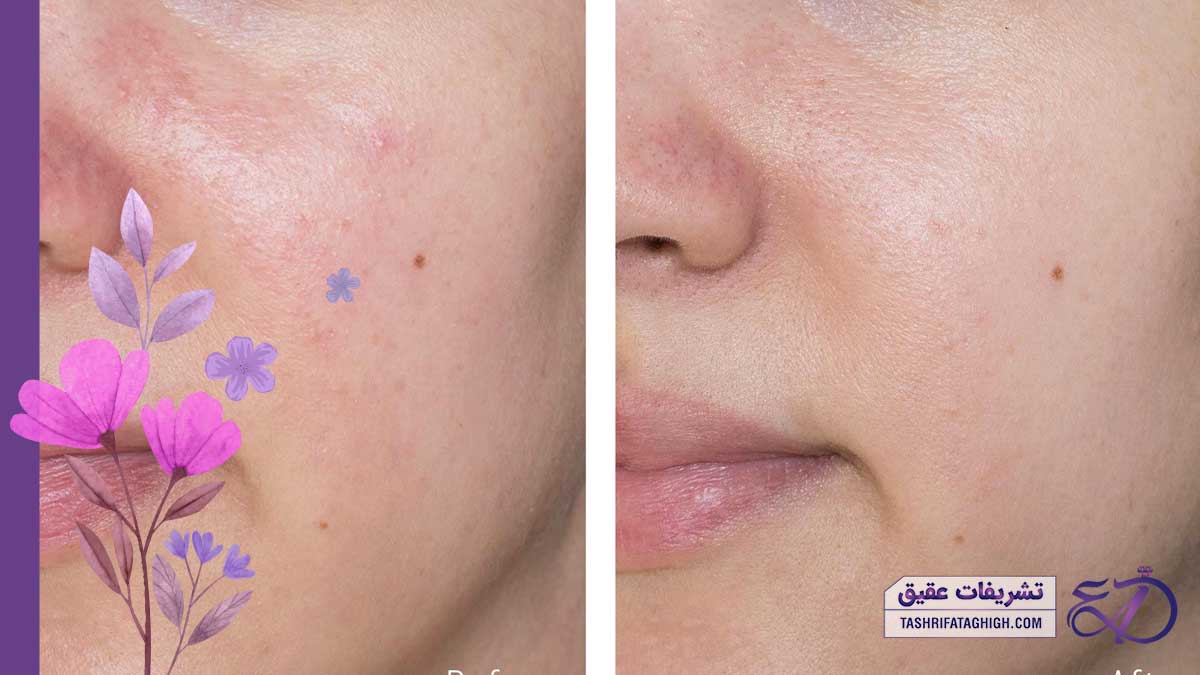عکس فیشیال صورت قبل و بعد