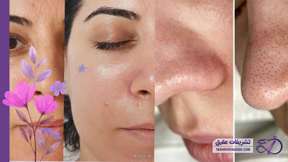 عکس فیشیال صورت قبل و بعد