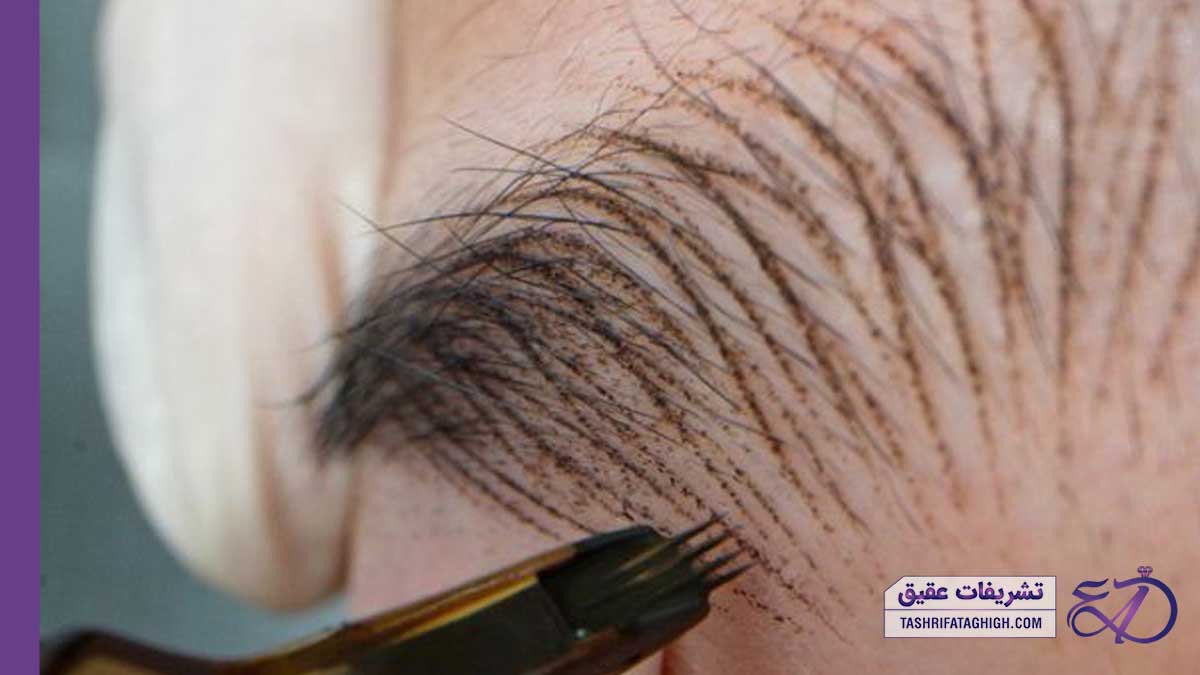 10 بهترین مرکز فیبروز ابرو در صدرا